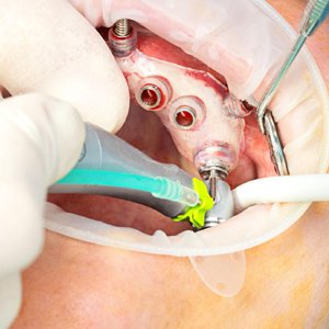 Advanced Implantology-300x300