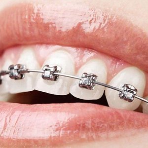 Orthodontics & Aligners- 300x300