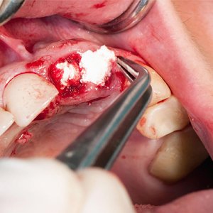 Regenerative Procedures-300x300 px